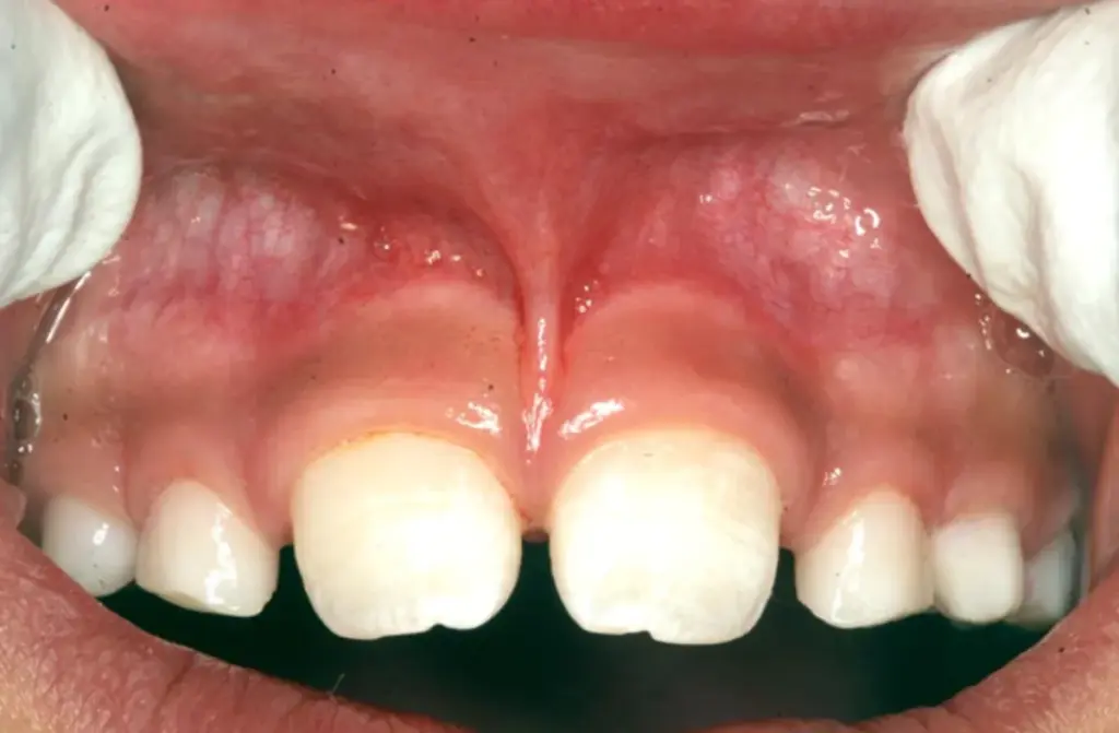 Gap in front teeth