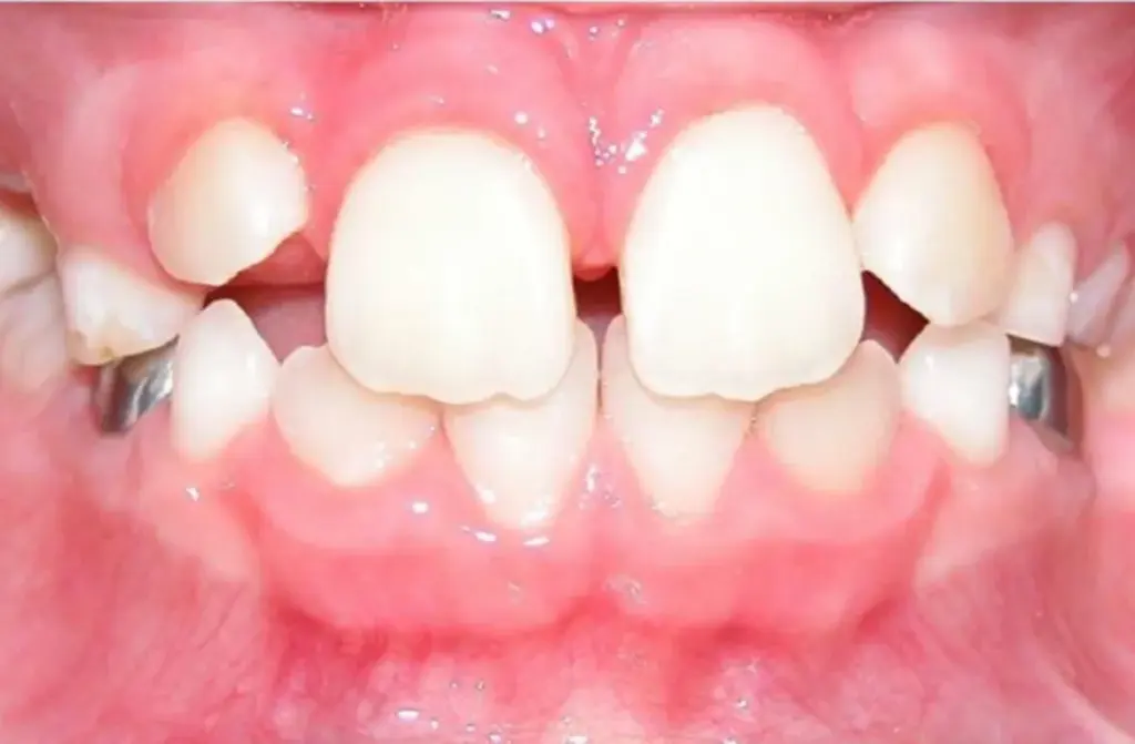 Gap in front teeth