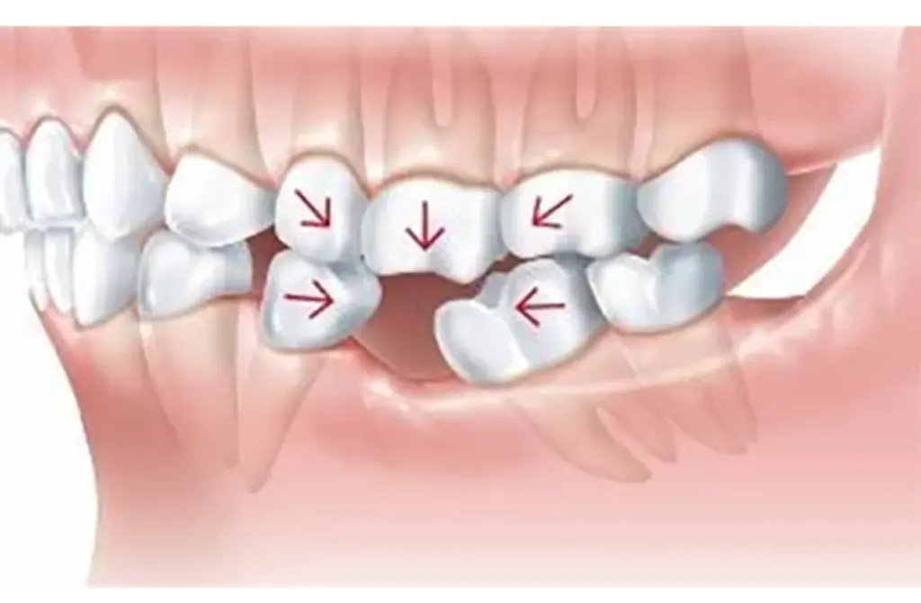 MISSING TEETH REPLACEMENT