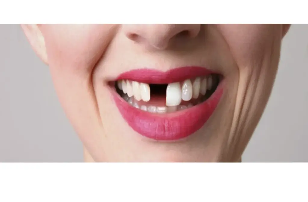 MISSING TEETH REPLACEMENT