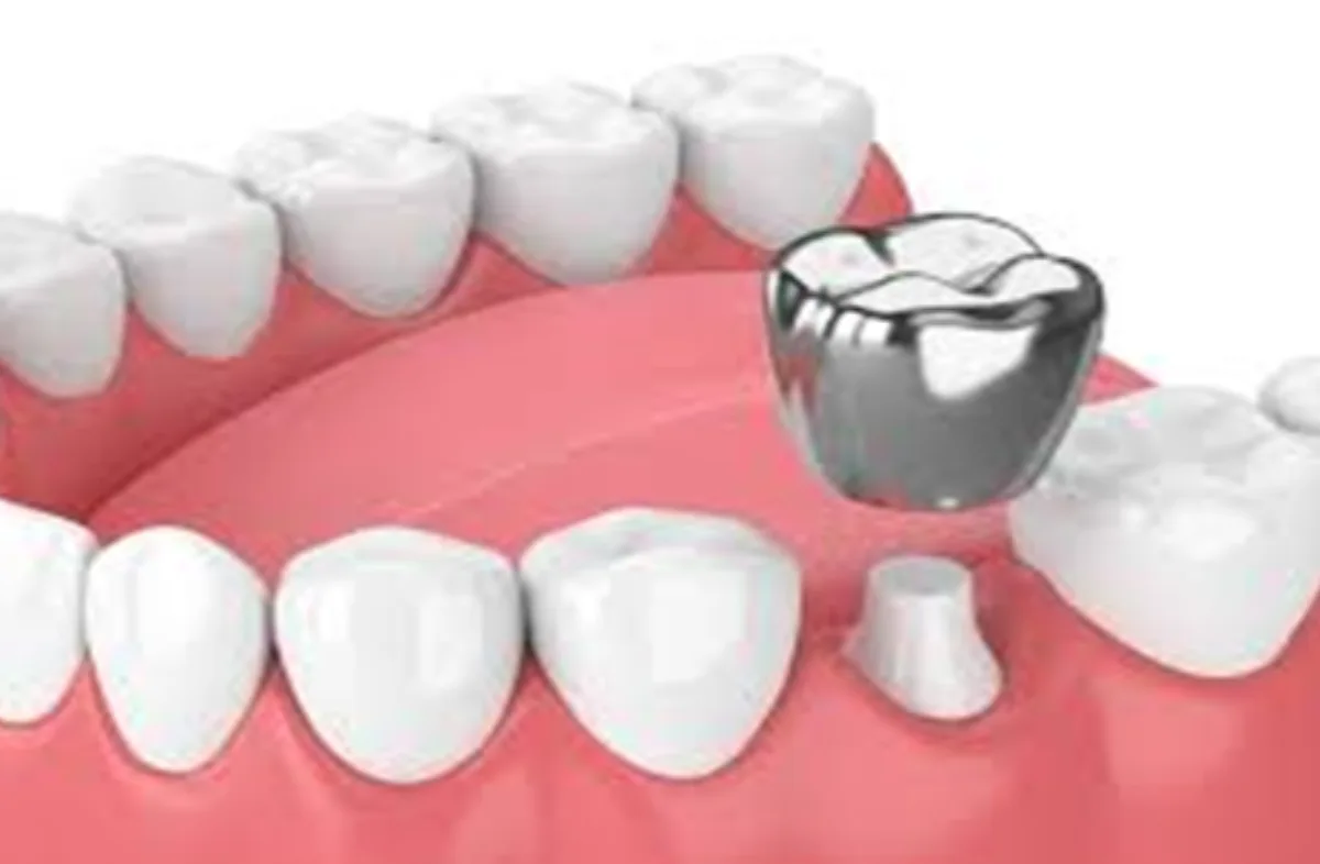 TOOTH CAP AND BRIDGE