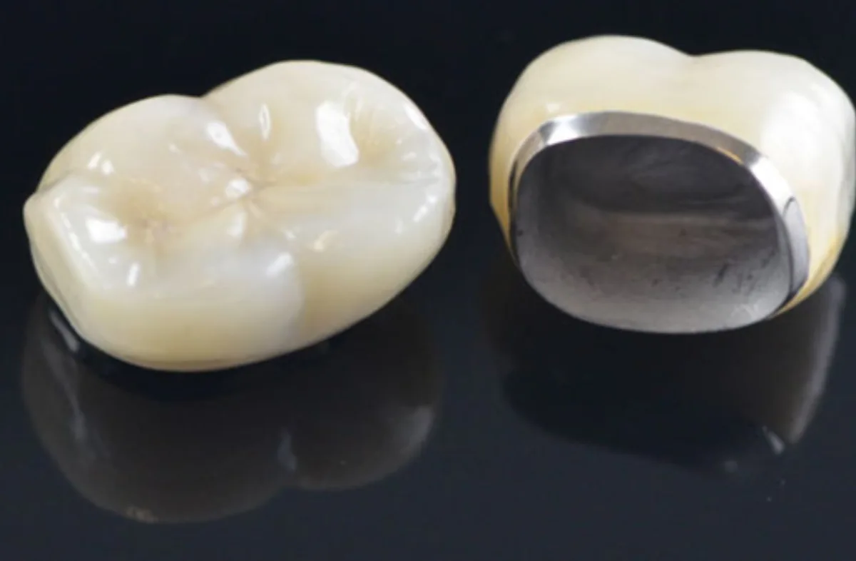 TOOTH CAP AND BRIDGE