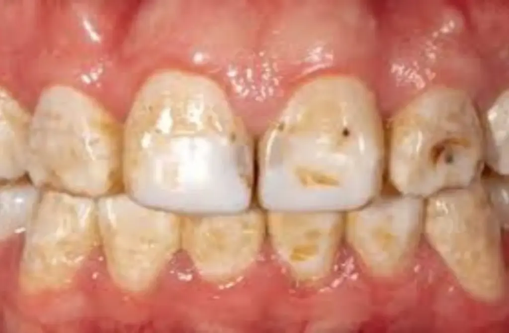Dental Fluorosis