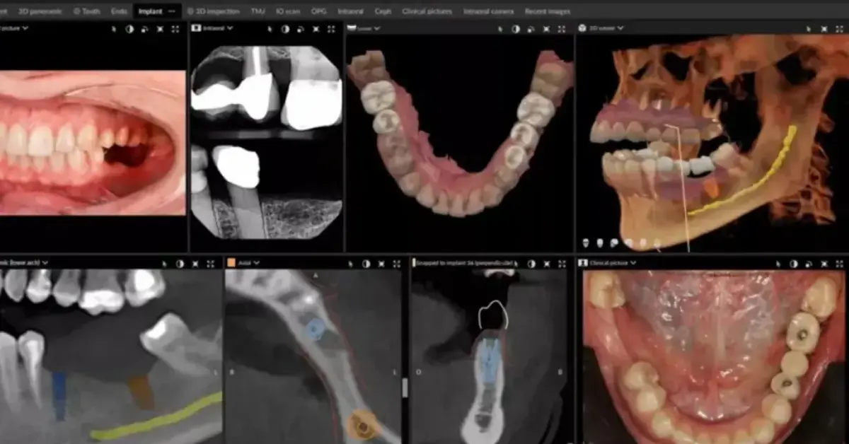 CBCT Guided Planning