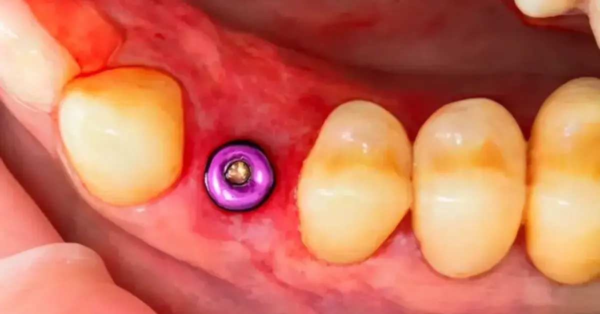 Failed Implant Management