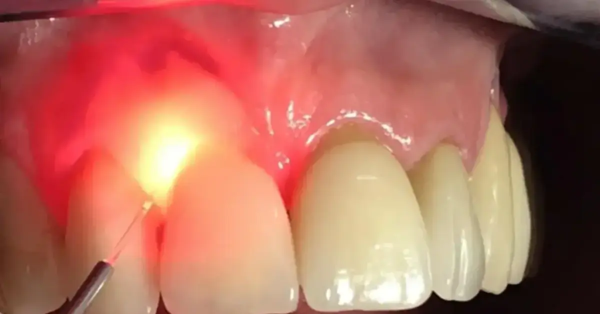 Gingival De Pigmentation