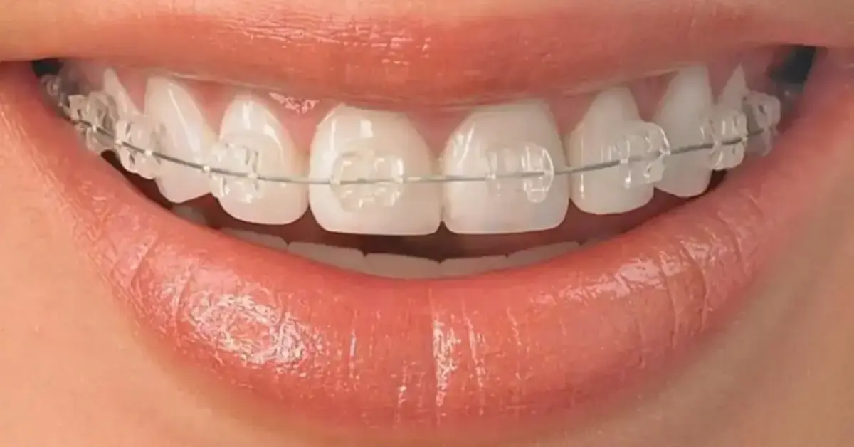 Ceramic Braces