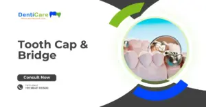 Chapter 16 Part -B- Tooth Cap & Bridge