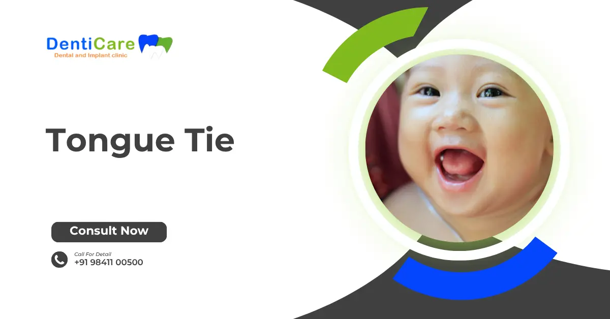 Chapter 18 - Tongue Tie