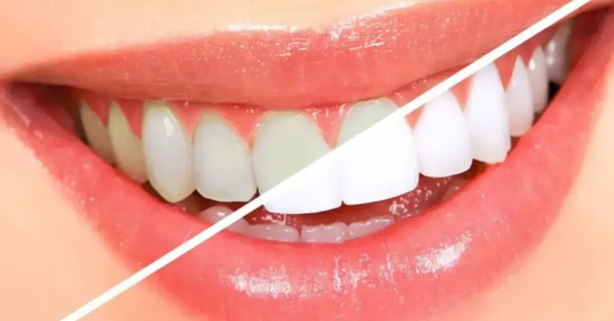 Teeth whitening/Bleaching